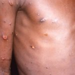 How Monkeypox Spread Across Nigeria in 2022